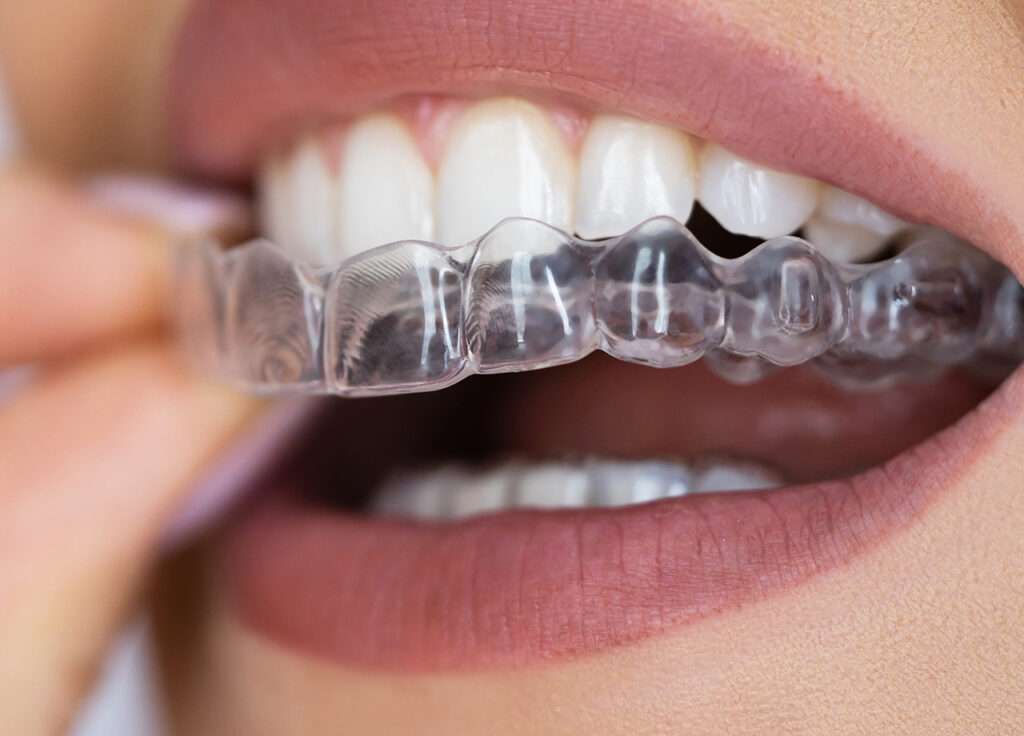 Woman putting her top row of clear aligners into her mouth.