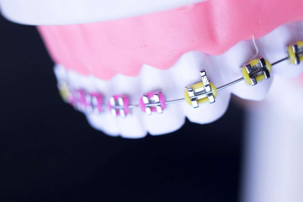 Model of teeth with multi-colored brackets for braces.