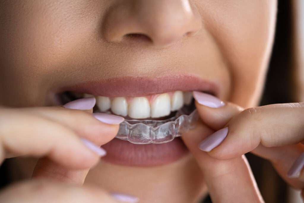 Woman with nail polish putting her clear aligners on her teeth.