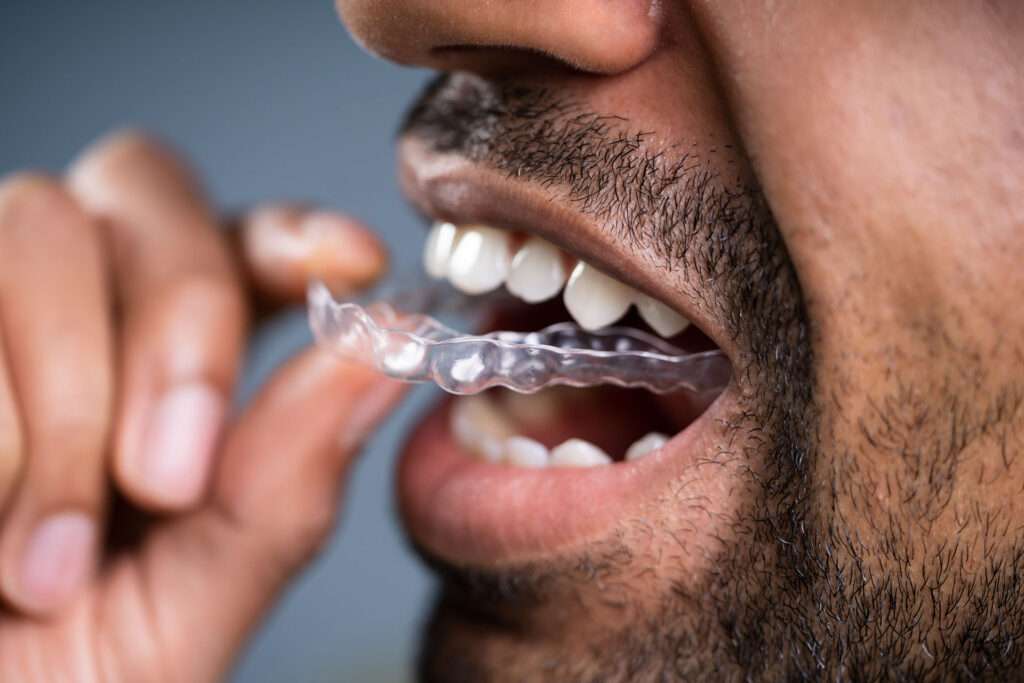 Close-up of a man with facial hair putting in his retainer.