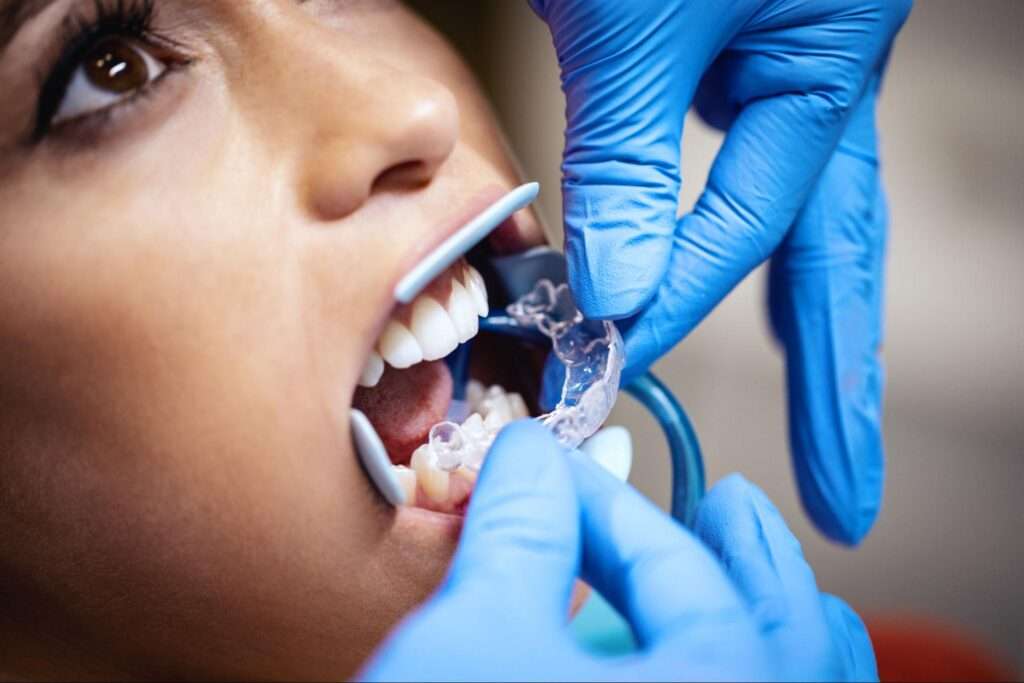 A close-up of a female patient receiving treatment for crowded teeth, with a dentist's hand in purple latex gloves carefully fitting clear aligners onto her teeth.