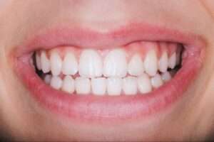 A close-up of a woman's smiling mouth, showcasing the successful results of crossbite treatment.