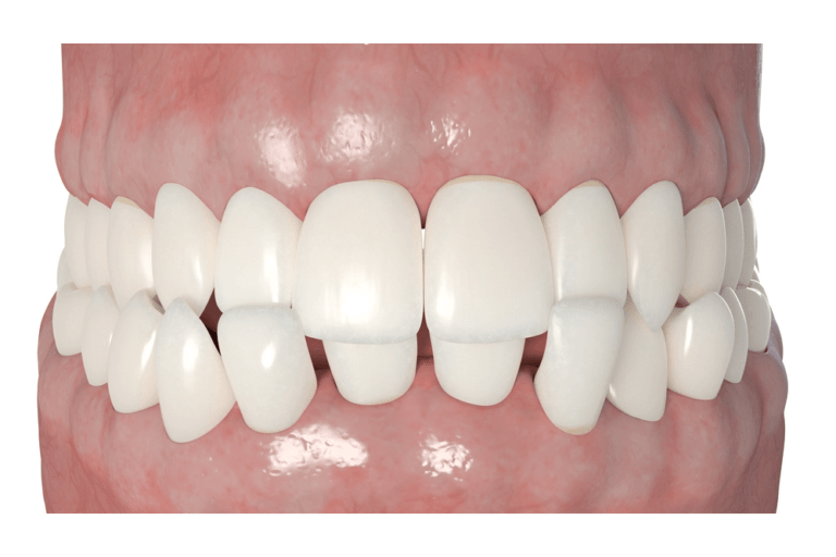 Can Aligners Fix Crossbite