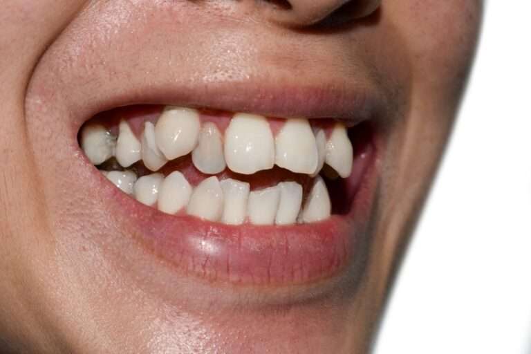 How to Fix Crooked Teeth